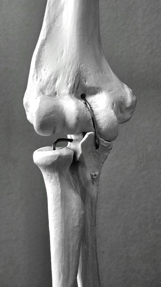 Ellbogen